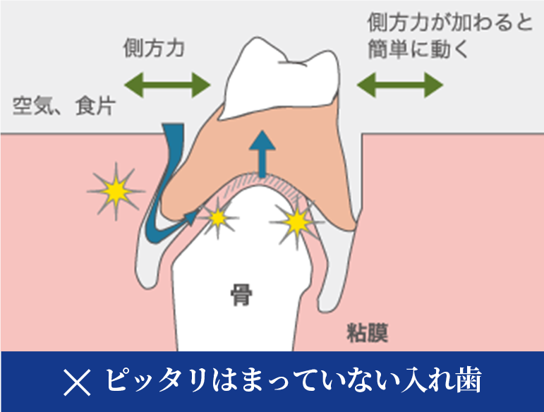 ×ピッタリはまっていない入れ歯の状態