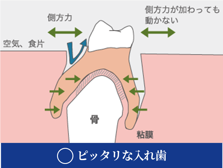 ○ピッタリな入れ歯