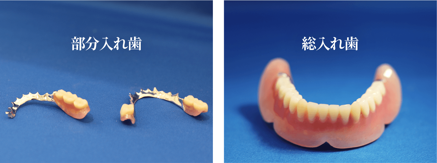 保険の部分入れ歯と総入れ歯
