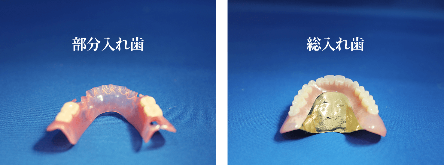 自費の部分入れ歯と総入れ歯