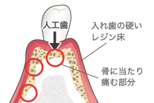 入れ歯で噛んだ場合