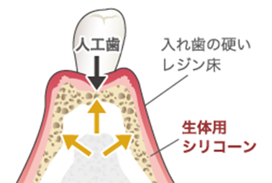 コンフォートデンチャーで噛んだ場合