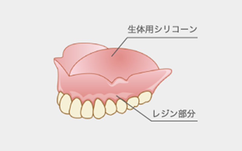コンフォートデンチャー